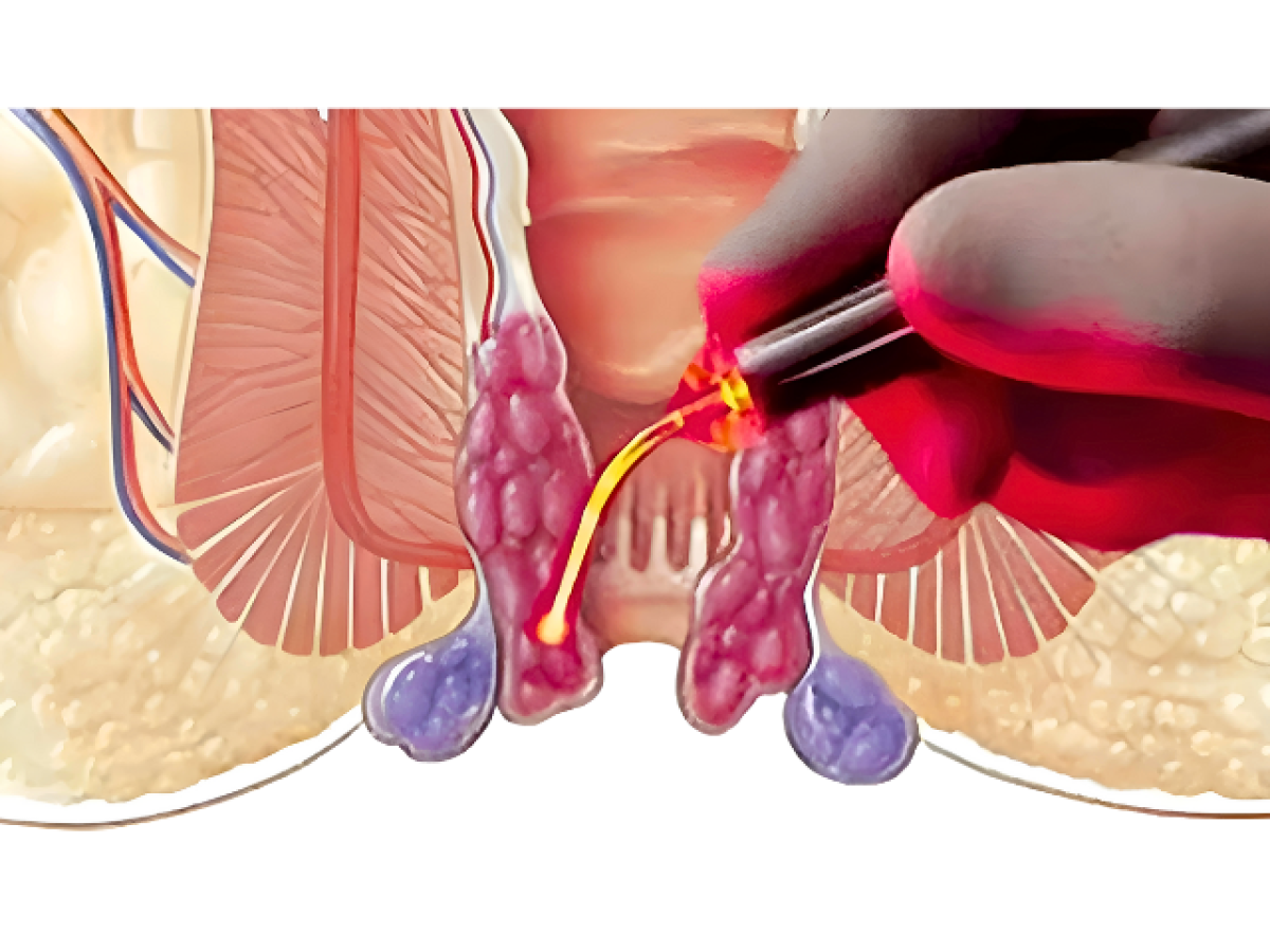best laser piles treatment in mira road